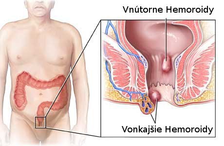 Vnútorne a vonkajšie hemoroidy